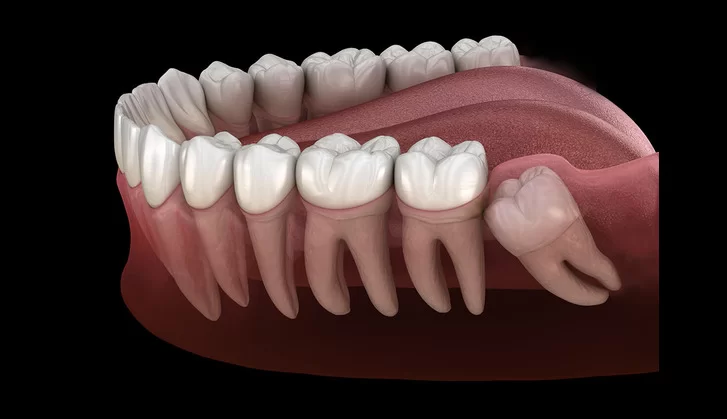 解析智慧齒：痛苦的源頭與拔除的考量