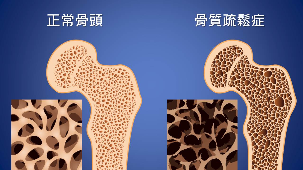 掌握這三個方法，骨質疏鬆不用怕！