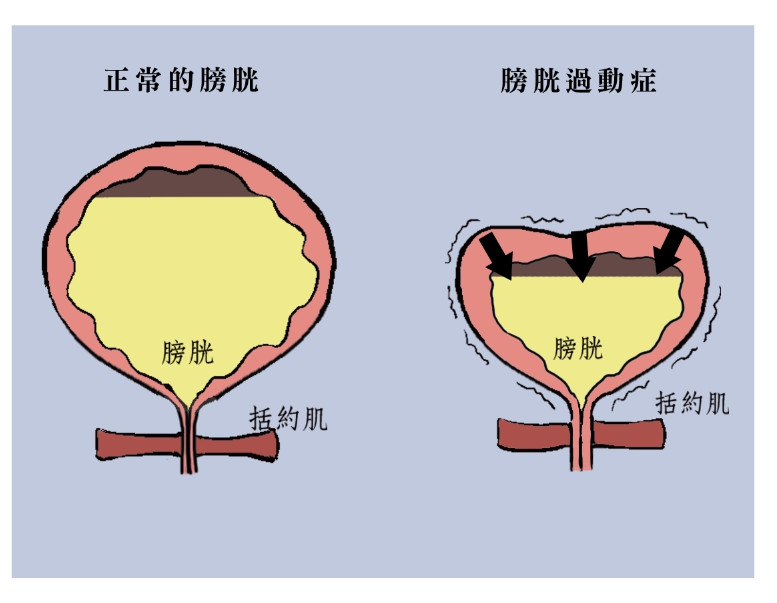 揭秘膀胱過動症的4大症狀